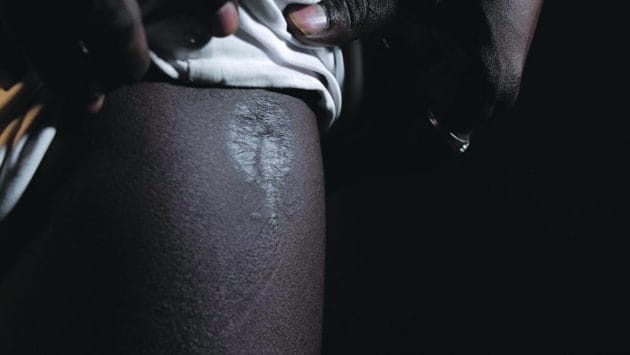 Scars from the bullet wound. Scars from the bullet wound.